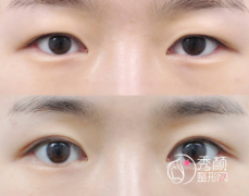 上海割双眼皮哪家好？上海九院、市六人民医院、华美、伊莱美…内附专家名单