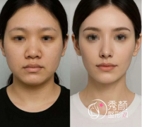 成都肋骨隆鼻好的医生排