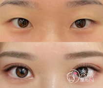 长沙割双眼皮哪家医院比较好？湘雅医院、湘雅二医院、省人民医院、美莱…实