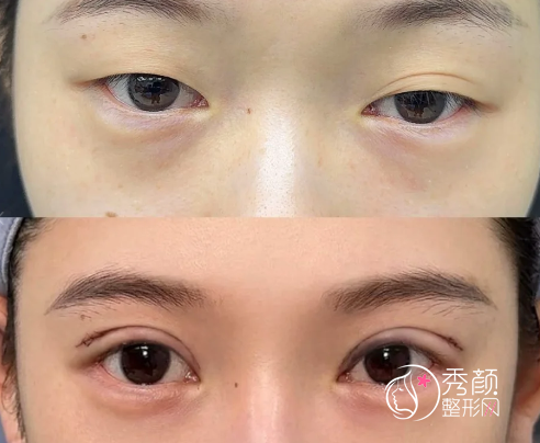 全国双眼皮医生排行榜：王太玲、朱海男、邹礼西、黄久佐…名列前茅