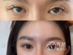 国内割双眼皮比较好的医
