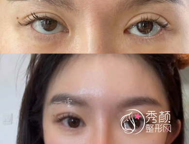 国内割双眼皮比较好的医院有哪些？上海九院、北医三院、西京医院、艺星…实力强！