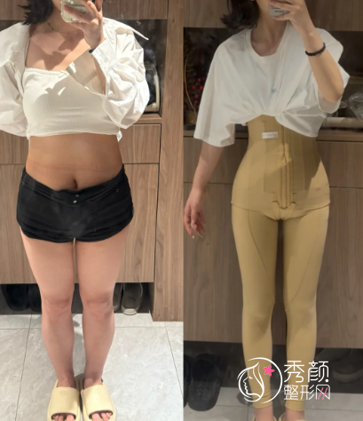 重庆吸脂比较好的医生有哪些？刘林奇、林文韬、王韶亮…经验丰富、技术精湛