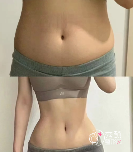 合肥吸脂好的医院有哪些？省立医院、艺星、华美、壹加壹…正规靠谱