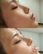 上海出名的隆鼻医生排名