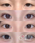 广州割双眼皮医生排名：