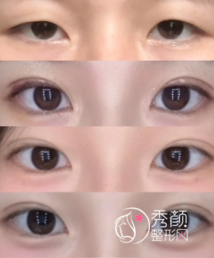 广州割双眼皮医生排名：范丹、刘志坤、赵成利、高建华…水准不错