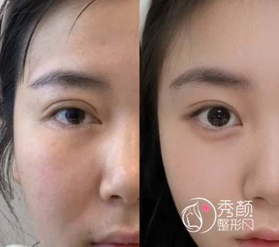 国内做双眼皮好的医生排名：于晓波、高伟成、邹礼西、梁伟强…名列前茅