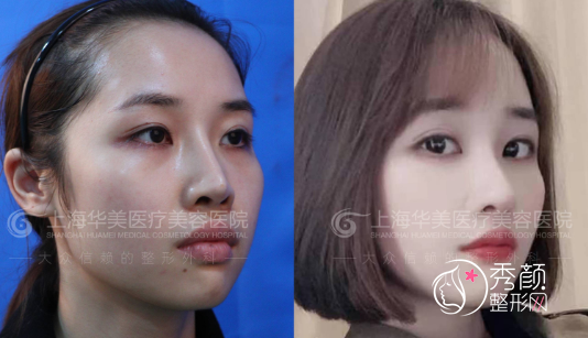 上海华美李健鼻子整形怎么样？擅长海鸥线定制、掌握脊状肋软骨技术、多种材料联合应用…