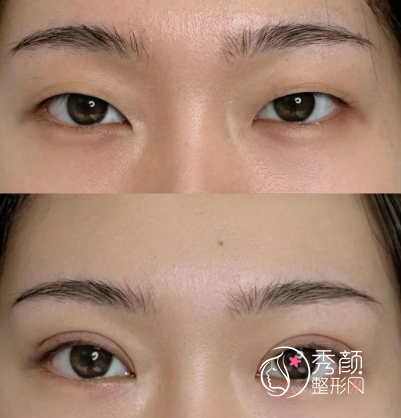 成都双眼皮专家排名：李正勇、段焘、余道江、蔡震…个个都是眼整形顶流