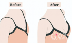 北京隆胸医生有哪