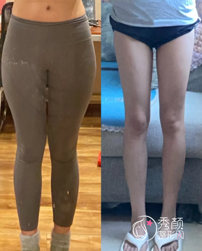 北京大腿吸脂医生排名榜：冯庆亮、袁杰、孙泽芳、于波…可谓是塑形大师