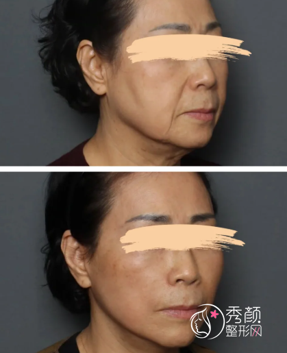 八大处谁做面部拉皮提升好啊？杨明勇、祁峰、侯典举、赵延勇…技术强