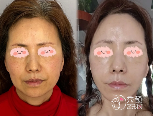 拉皮手术全国超厉害三个医生：黄寅守、杜太超、祝东升，人气出众