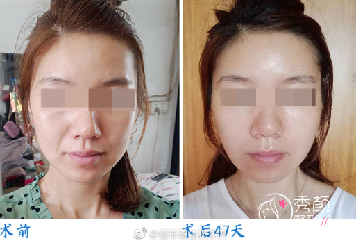 祝东升医生做面部拉皮多少钱？经典拉皮3.5W起，附技术特点展示