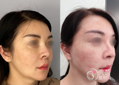 国内做拉皮手术有名的医