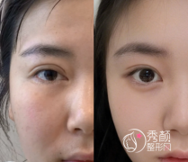 郑州双眼皮整形医院排行榜：省人民医院、郑大二附院、天后、河南整形美容医