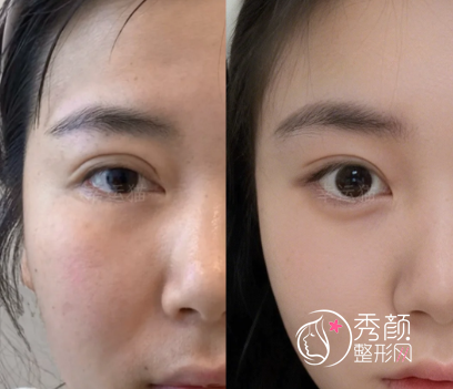 郑州双眼皮整形医院排行榜：省人民医院、郑大二附院、天后、河南整形美容医院…