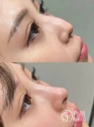 北京隆鼻超厉害的三个医生：龙飞、刘彦军、薛红宇…实力大咖展示