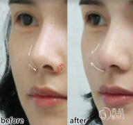 北京隆鼻哪里做的好？协和医院、北医三院、朝阳医院、华韩…各有优势