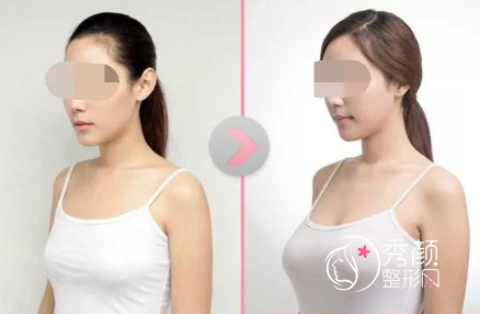 天津隆胸做的好的医生有哪些？董岩岩、涂增峰、熊斌、刘旺…人气出众