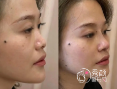 长沙隆鼻整形医院排名：