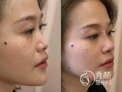 长沙隆鼻整形医院排名：湘雅二医院、美莱、亚韩…可谓是佼佼者