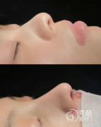 长沙隆鼻医生推荐：王先