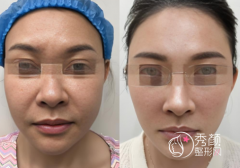 南京拉皮手术哪个医生做的好？侯祚琼、郝文玉、许恺燕、吴国平