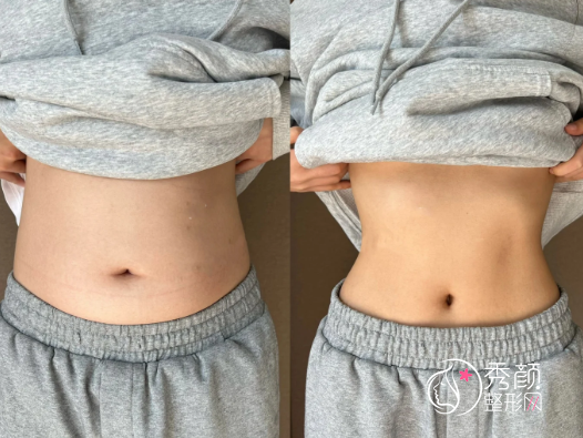 北京吸脂医生推荐：谷廷敏、顾云鹏、王阳、李石…专业水准高