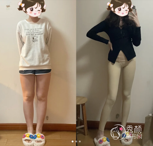 彭义坤吸脂做的怎么样？经验丰富、个性化塑形、创伤小…附医生详情介绍