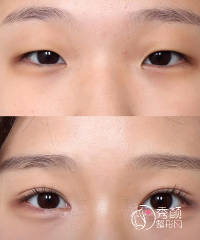 深圳做双眼皮医院排行榜：市人民医院、龙岗中心医院、阳光医美…医生技术稳