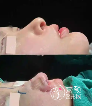 范锴医生鼻子整形怎么样？收费价格参考&隆鼻案例&坐诊机构一览