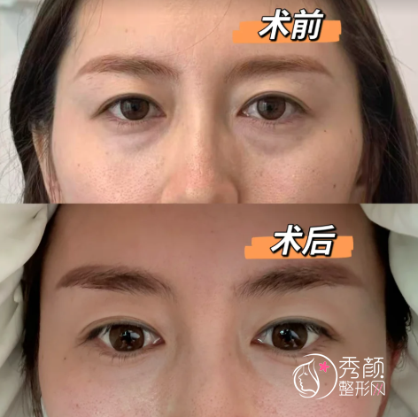 深圳眼袋手术超好的医院排名：阳光、鹏程、丽港丽格、美莱…技术优势多