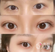 深圳割双眼皮口碑好的医