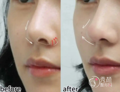 北京隆鼻修复超好的三甲