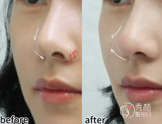 北京隆鼻修复超好的三甲医院排名：北大人民医院、八大处、中日友好、北医三院…