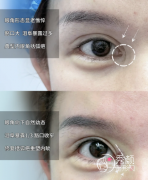 北京高难度内眼角修复专