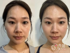 上海脂肪填充整形医院哪