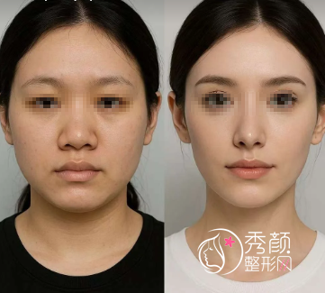 上海超有名鼻子整形专家排名榜：魏皎、丁志、皮庆猛、钱玉鑫…口碑好！