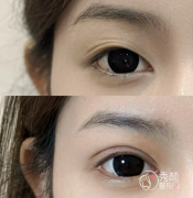 郑州做双眼皮的医生哪个好？李文祥、朱纪国、翟弘峰、刘德辉…实力强