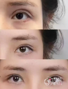 青岛双眼皮修复超好的医生有哪些？刘学源、陈振雨、姜留刚…优势出众