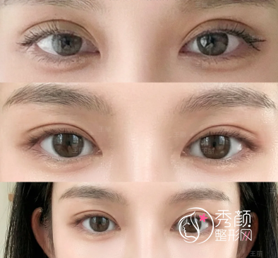 武汉割双眼皮哪个医院好？艺星、壹加壹、华韩、韩辰、伽美…实力出众