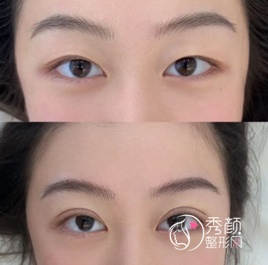 北京做双眼皮手术哪家医院好？上榜均是当地热门且口碑不错的专业机构