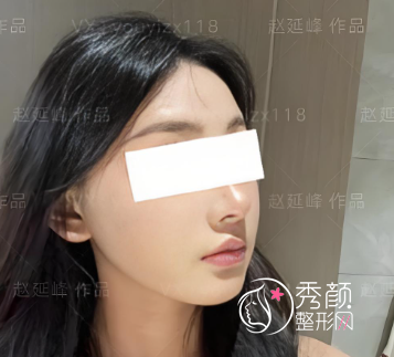 赵延峰做下颌角怎么样？塑形精准、缩小脸型的效果明显、血肿轻微…