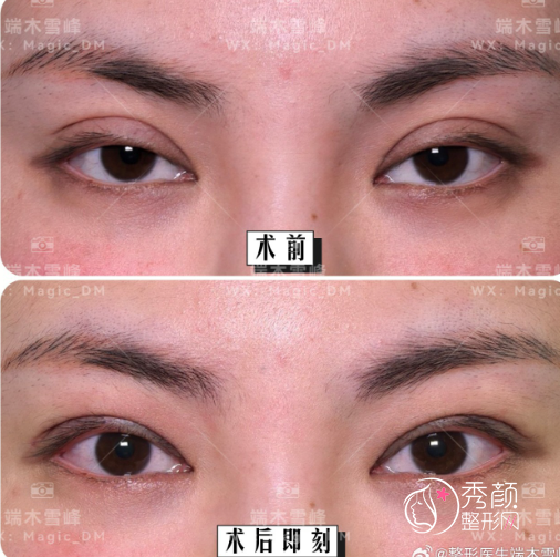 苏州吴中维多利亚端木雪峰做双眼皮怎么样？技术过硬、效果好！