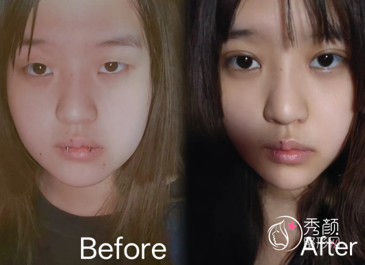 北京割双眼皮超好的公立医院有哪些？协和、北医三院、解放军总医院…火热上榜