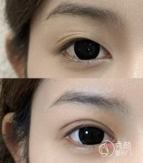 苏州哪里做双眼皮比较好