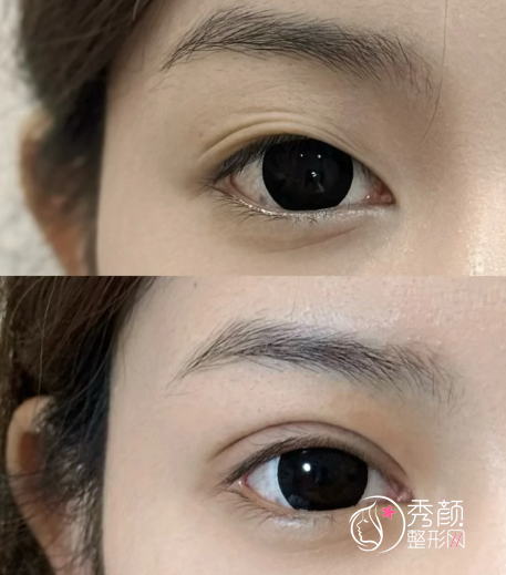 苏州哪里做双眼皮比较好？苏大附二院、苏大附一院、美贝尔美容…技术出众