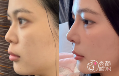 深圳隆鼻厉害的专家是谁